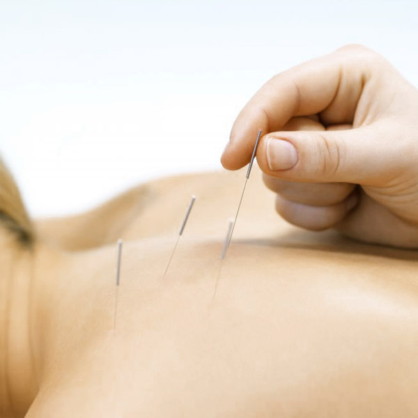 acupuncture tynemouth, paediatric acupuncture