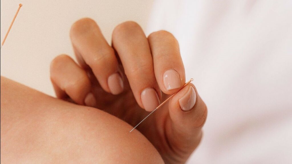 Therapist applying Acupuncture treatment