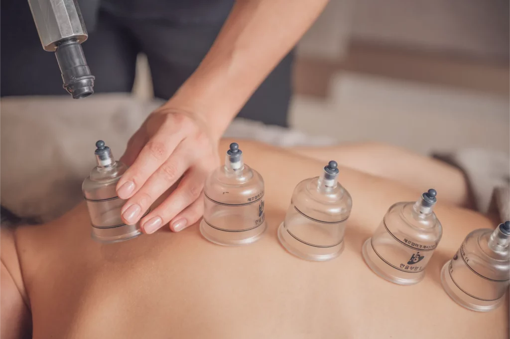 masseur using cupping therapy on her client 2023 11 27 04 53 13 utc