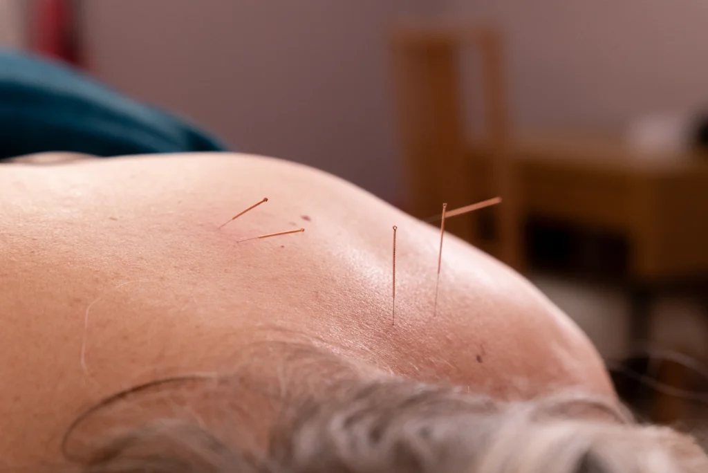 ACUPUNCTURE 2 Credit Joel Lowson Videography 02