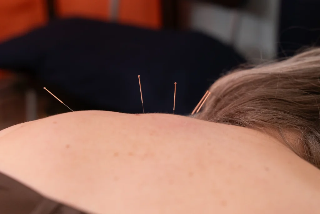 ACUPUNCTURE Credit Joel Lowson Videography 01